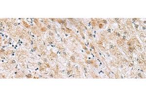 Immunohistochemistry of paraffin-embedded Human liver cancer tissue using GPC2 Polyclonal Antibody at dilution of 1:40(x200) (GPC2 antibody)
