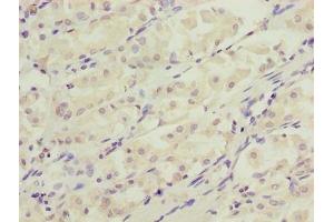 Immunohistochemistry of paraffin-embedded human gastric cancer using ABIN7150132 at dilution of 1:100 (DDIT3 antibody  (AA 1-169))