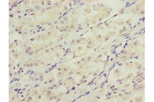 Immunohistochemistry of paraffin-embedded human gastric cancer using ABIN7150132 at dilution of 1:100 (DDIT3 antibody  (AA 1-169))