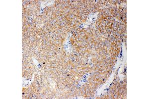 Anti-Caspase-12 antibody, IHC(P) IHC(P): Human Lung Cancer Tissue (Caspase 12 antibody  (N-Term))