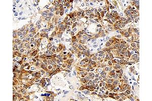 Immunohistochemistry analysis of paraffin-embedded human lung cancer using CD107b Polyclonal Antibody at dilution of 1:300. (LAMP2 antibody)