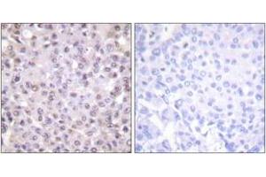 Immunohistochemistry analysis of paraffin-embedded human breast carcinoma tissue, using NCoR1 Antibody.