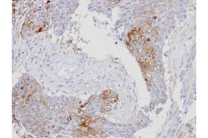 IHC-P Image Immunohistochemical analysis of paraffin-embedded human lung SCC, using RanBP16, antibody at 1:100 dilution. (Exportin 7 antibody  (C-Term))