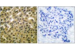 Immunohistochemistry analysis of paraffin-embedded human breast carcinoma, using GSK3 alpha/beta (Phospho-Tyr279/216) Antibody. (GSK3 alpha/beta antibody  (pTyr279))