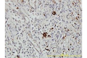 Immunoperoxidase of monoclonal antibody to ORM1 on formalin-fixed paraffin-embedded human stomach carcinoma tissue. (ORM1 antibody  (AA 18-201))