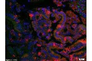 Formalin-fixed and paraffin embedded human cervical carcinoma labeled with Anti- LONP1 Polyclonal Antibody, Unconjugated (ABIN705806) at 1:200 followed by conjugation to the secondary antibody (LONP1 antibody  (AA 361-460))