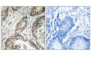 Immunohistochemistry analysis of paraffin-embedded human colon carcinoma tissue using TUT1 antibody. (TUT1 antibody)