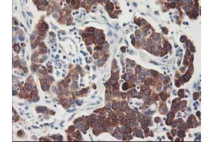 Immunohistochemical staining of paraffin-embedded Carcinoma of Human lung tissue using anti-FDFT1 mouse monoclonal antibody.