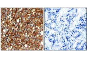 Immunohistochemical analysis of paraffin-embedded human lung carcinoma tissue, using CD340 / ERBB2 / HER2 Antibody (pTyr1248) (ErbB2/Her2 antibody  (pTyr1248))