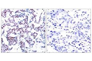 Immunohistochemical analysis of paraffin-embedded human breast carcinoma tissue using JunB(Phospho-Ser259) Antibody(left) or the same antibody preincubated with blocking peptide(right). (JunB antibody  (pSer259))