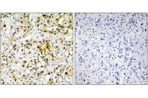 Immunohistochemistry analysis of paraffin-embedded human liver carcinoma tissue, using LEG4 Antibody. (GAL4 antibody  (AA 61-110))