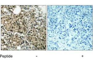 Imunohistochemical analysis of paraffin-embedded human breast carcinoma tissue using G3BP1 polyclonal antibody .