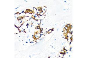 Immunohistochemistry of paraffin-embedded Human lung cancer using  Rabbit pAb (ABIN6131176, ABIN6136646, ABIN6136647 and ABIN6222857) at dilution of 1:100 (40x lens). (AGR2 antibody  (AA 21-175))