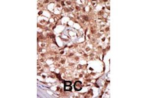 Formalin-fixed and paraffin-embedded human cancer tissue reacted with RIPK2 polyclonal antibody  , which was peroxidase-conjugated to the secondary antibody, followed by AEC staining. (RIPK2 antibody  (C-Term))