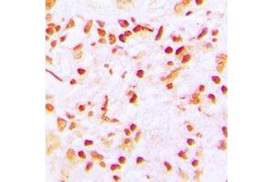 Immunohistochemical analysis of CENPA staining in human lung cancer formalin fixed paraffin embedded tissue section.