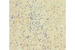 Immunohistochemistry of paraffin-embedded human liver cancer using ABIN7159631 at dilution of 1:100 (MCCC1 antibody  (AA 526-725))