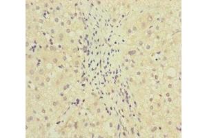 Immunohistochemistry of paraffin-embedded human liver cancer using ABIN7159631 at dilution of 1:100 (MCCC1 antibody  (AA 526-725))