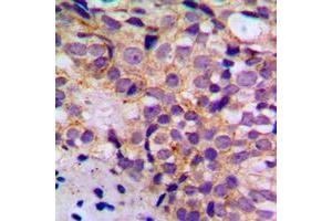 Immunohistochemical analysis of BIM (pS69) staining in human breast cancer formalin fixed paraffin embedded tissue section. (BIM antibody  (pSer69))