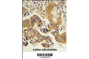 Formalin-fixed and paraffin-embedded human colon carcinoma reacted with CLNS1A Antibody , which was peroxidase-conjugated to the secondary antibody, followed by DAB staining. (CLNS1A antibody  (AA 148-176))