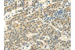 The image on the left is immunohistochemistry of paraffin-embedded Human liver cancer tissue using ABIN7130215(MED16 Antibody) at dilution 1/20, on the right is treated with fusion protein.