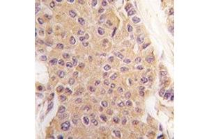 IHC analysis of FFPE human breast carcinoma tissue stained with TGF Beta 2 antibody (TGFB2 antibody  (AA 277-306))