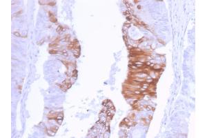 Formalin-fixed, paraffin-embedded human Colon Carcinoma stained with Cytokeratin 20 Recombinant Rabbit Monoclonal Antibody (KRT20/3129R).