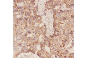 Anti-FSH beta Picoband antibody,  IHC(P): Human Mammary Cancer Tissue (FSHB antibody  (AA 19-129))
