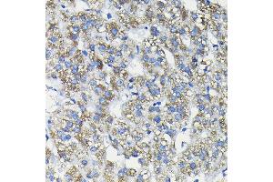 Immunohistochemistry of paraffin-embedded human liver cancer using FUC Rabbit pAb (ABIN6127916, ABIN6140809, ABIN6140811 and ABIN6215812) at dilution of 1:200 (40x lens). (FUCA2 antibody  (AA 118-467))