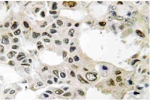Immunohistochemistry (IHC) analyzes of eIF3D antibody staining in Paraffin-Embedded Human breast carcinoma tissue. (EIF3D antibody)