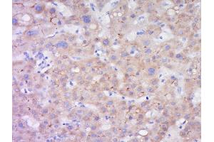 Paraformaldehyde-fixed, paraffin embedded human liver carcinoma, Antigen retrieval by boiling in sodium citrate buffer (pH6) for 15min, Block endogenous peroxidase by 3% hydrogen peroxide for 30 minutes, Blocking buffer (BSA or normal goat serum) at 37°C for 20min, Antibody incubation with LIPC Polyclonal Antibody, Unconjugated  at 1:200 overnight at 4°C, followed by a conjugated secondary (sp-0023) for 20 minutes and DAB staining. (LIPC antibody  (AA 301-400))