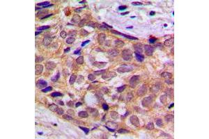 Immunohistochemical analysis of 14-3-3 theta staining in human prostate cancer formalin fixed paraffin embedded tissue section. (14-3-3 theta antibody  (Center))