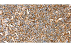 Immunohistochemistry of paraffin-embedded Human cervical cancer tissue using SLC8A3 Polyclonal Antibody at dilution 1:35 (SLC8A3 antibody)