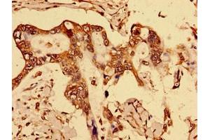 Immunohistochemistry of paraffin-embedded human breast cancer using ABIN7150562 at dilution of 1:100 (DOK1 antibody  (AA 1-481))