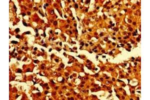 Immunohistochemistry of paraffin-embedded human breast cancer using ABIN7146907 at dilution of 1:100 (CARD14 antibody  (AA 249-523))