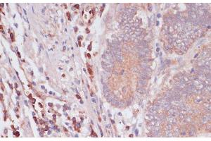 Immunohistochemistry of paraffin-embedded Human colon carcinoma using IFNAR2 Polyclonal Antibody at dilution of 1:100 (40x lens). (IFNAR2 antibody)