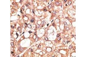 IHC analysis of FFPE human hepatocarcinoma stained with the LSD1 antibody (LSD1 antibody  (AA 457-490))
