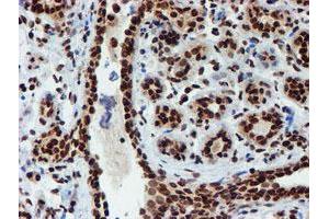Immunohistochemical staining of paraffin-embedded Human breast tissue using anti-PADI4 mouse monoclonal antibody. (PAD4 antibody)