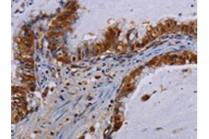 The image on the left is immunohistochemistry of paraffin-embedded Human esophagus cancer tissue using ABIN7130211(MECP2 Antibody) at dilution 1/60, on the right is treated with fusion protein.