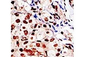 IHC analysis of FFPE human breast carcinoma tissue stained with the SUMO antibody (SUMO1 antibody  (AA 52-79))