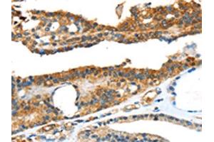 The image on the left is immunohistochemistry of paraffin-embedded Human thyroid cancer tissue using ABIN7131111(SNAI3 Antibody) at dilution 1/20, on the right is treated with fusion protein. (SNAI3 antibody)