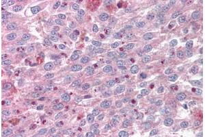 Anti-KLF4 antibody IHC staining of human melanoma. (KLF4 antibody  (AA 80-129))