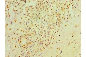 Immunohistochemistry of paraffin-embedded human breast cancer using ABIN7162034 at dilution of 1:100 (NXNL1 antibody  (AA 1-200))