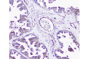 IHC analysis of INPPL1 using anti-INPPL1 antibody (ABIN6719492). (INPPL1 antibody  (AA 1172-1258))