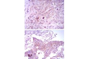 Immunohistochemical analysis of paraffin-embedded human lung cancer tissues (upper) and ovarian cancer tissues (bottom) using FOXD3 monoclonal antibody, clone 5G9  with DAB staining. (FOXD3 antibody)