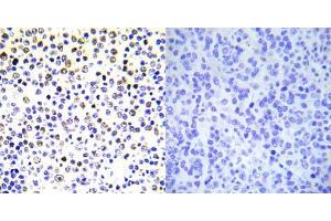 Immunohistochemical analysis of paraffin- embedded human malignant lymphoma tissue using Histone H3. (Histone H3.1 antibody)