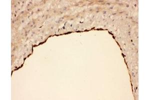 IHC-P: COX1 antibody testing of human lung cancer tissue (COX1 antibody  (AA 318-599))