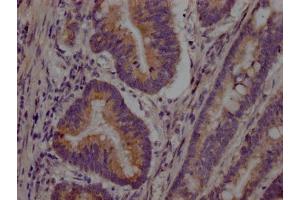 IHC image of ABIN7127668 diluted at 1:100 and staining in paraffin-embedded human colon cancer performed on a Leica BondTM system. (Recombinant PCSK9 antibody)