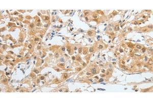 Immunohistochemistry of paraffin-embedded Human liver cancer tissue using BPIFB2 Polyclonal Antibody at dilution 1:45 (BPIL1 antibody)