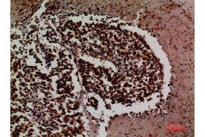 Immunohistochemistry (IHC) analysis of paraffin-embedded Human Lung Cancer, antibody was diluted at 1:100. (ICAM-3/CD50 antibody  (Internal Region))