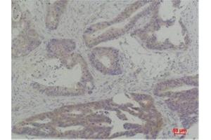 Immunohistochemistry (IHC) analysis of paraffin-embedded Human Breast Carcinoma using TBP Rabbit Polyclonal Antibody diluted at 1:200.